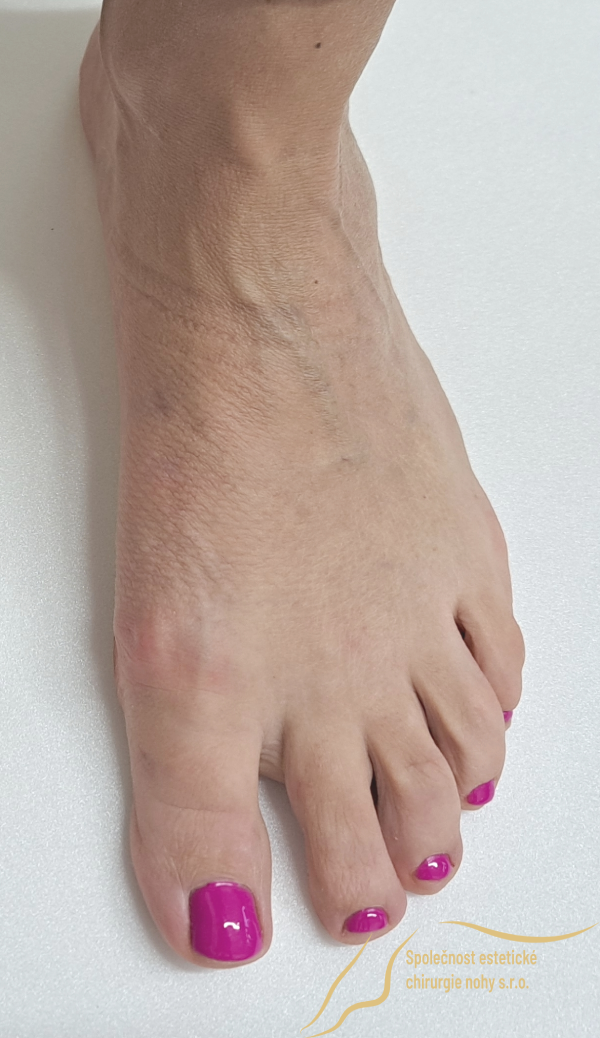 12 months after bunion surgery